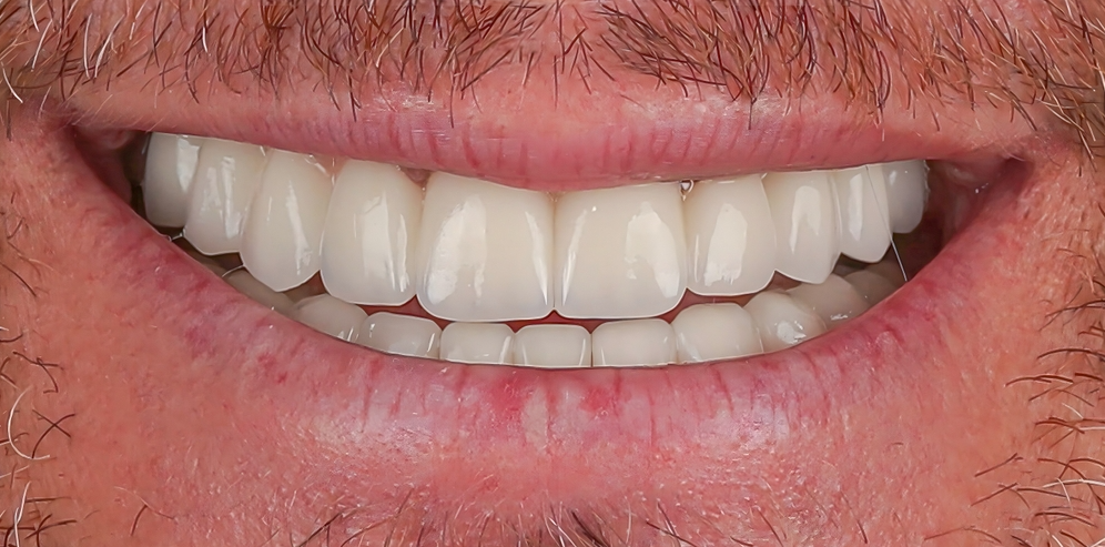 After Invisalign treatment