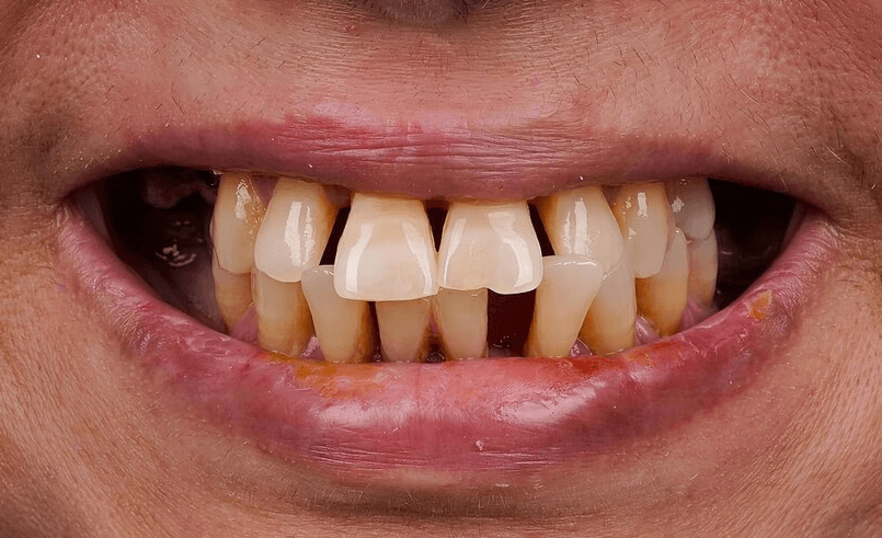 Before Invisalign treatment