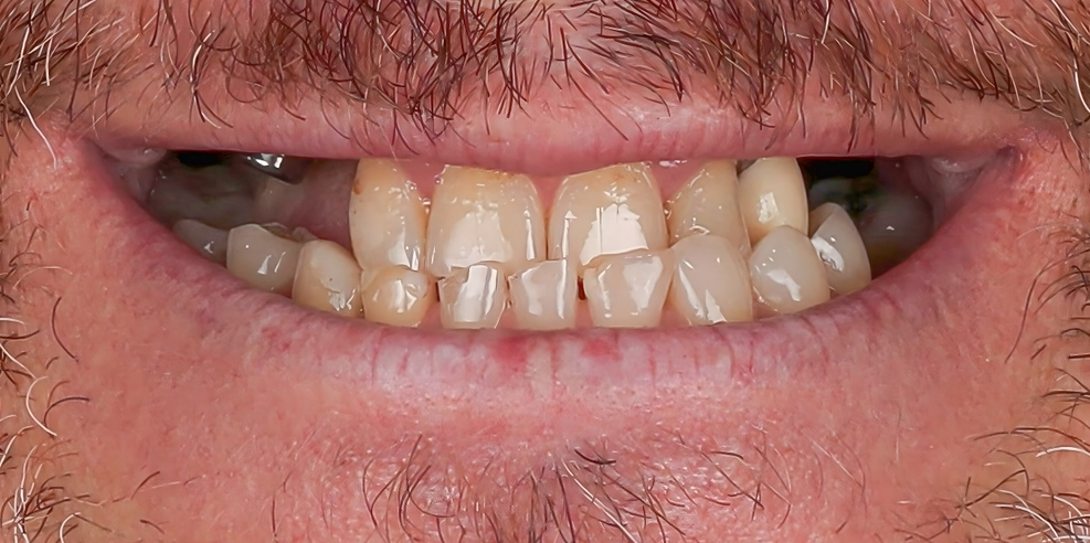 Before Invisalign treatment