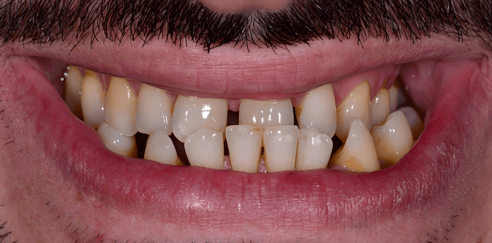 Before Invisalign treatment