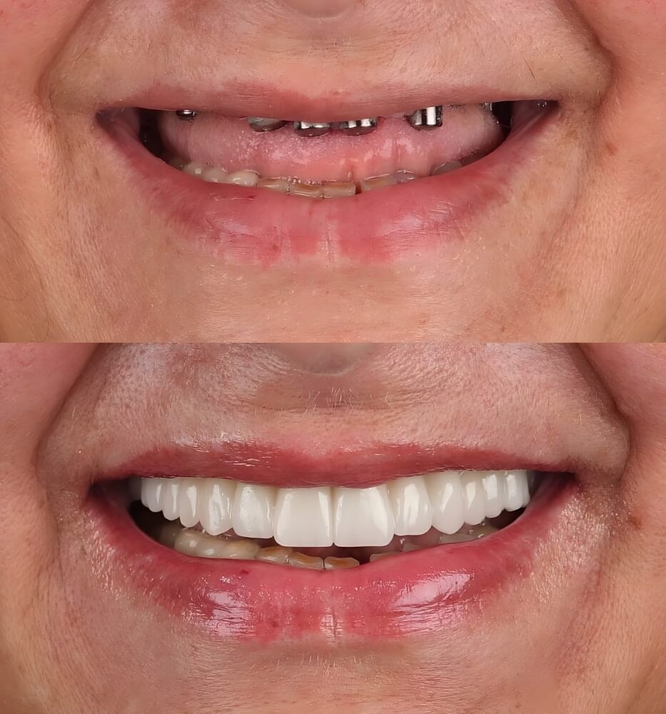 Before and after dental implants - Complete smile restoration