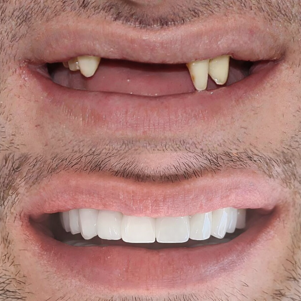 Before and after dental implants transformation